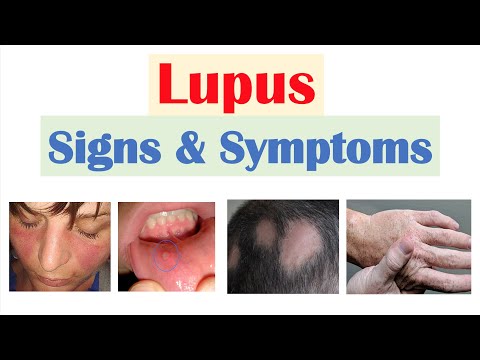 What is the definition of lupus?