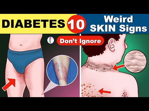 What is the sensation of itching for diabetics?