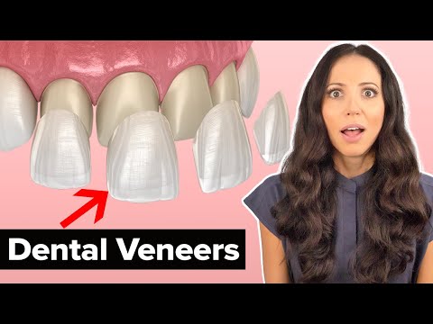 What is the appearance of teeth beneath veneers?
